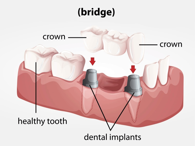 dental implants Dental Health International dentist in Chelsea, MA Dr. Jeya Guna Dr. Luxmi Guna Dr. Aynka Guna Dr. Anuradha Deshmukh Dr. Oleg (Alex) Agranovich Dr. Angela Lin Dr. Jubin Zaboulian Dr. Rekha Hariwala
