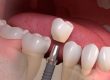 Replace Your Missing Teeth with Dental Implants dental health international dentist in chelsea MA