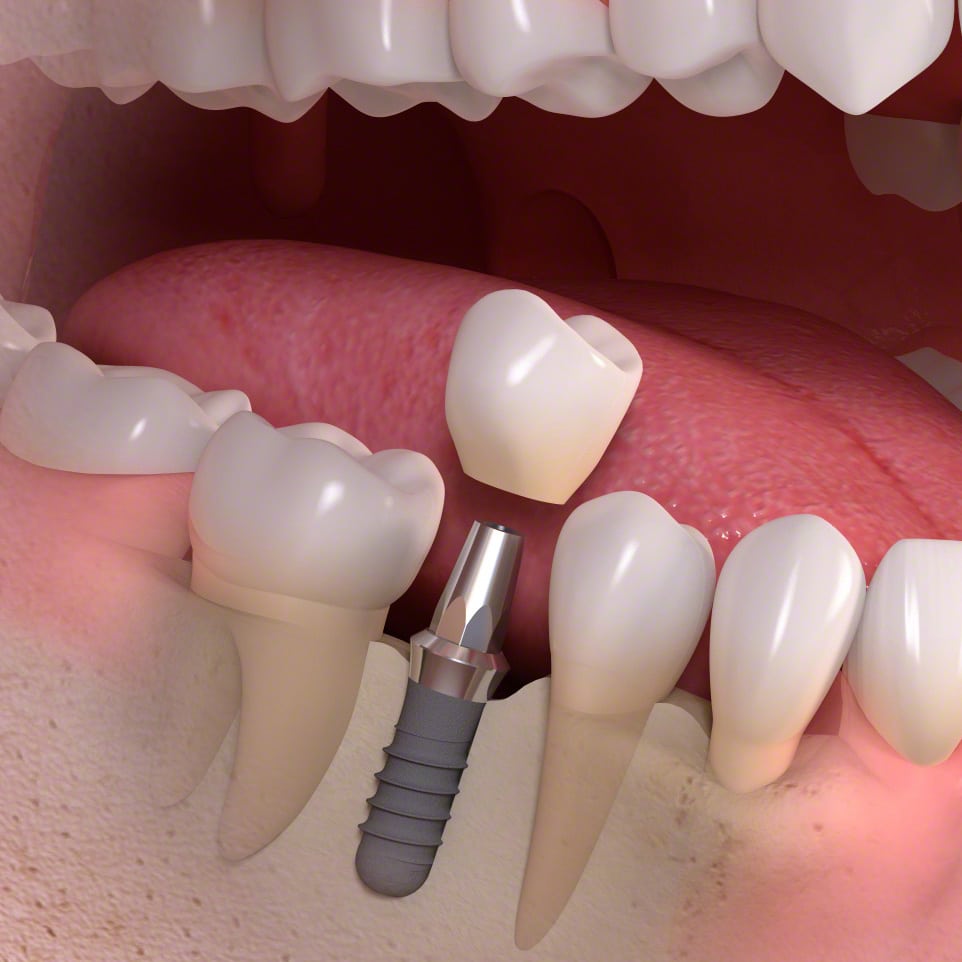 Replace Your Missing Teeth with Dental Implants dental health international dentist in chelsea MA Replace Your Missing Teeth with Dental Implants dental health international dentist in chelsea MA