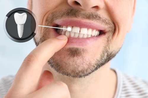 dental implants east boston dental implants east boston