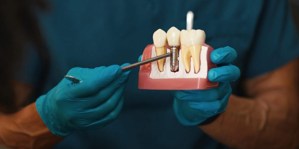 Illustrating,Dental,Implant,Procedure,On,Model dental implants chelsea