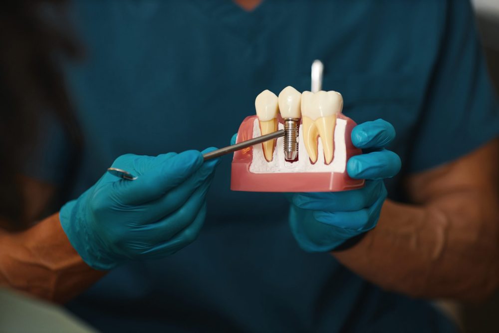 Illustrating,Dental,Implant,Procedure,On,Model dental implants chelsea