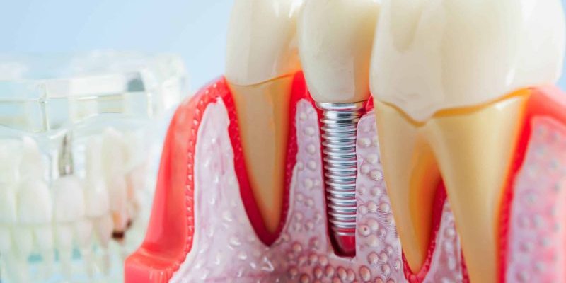 Artificial,Tooth,Roots,Dental,Implant,Into,Jaw,,Root,Canal,Model full arch dental implants boston