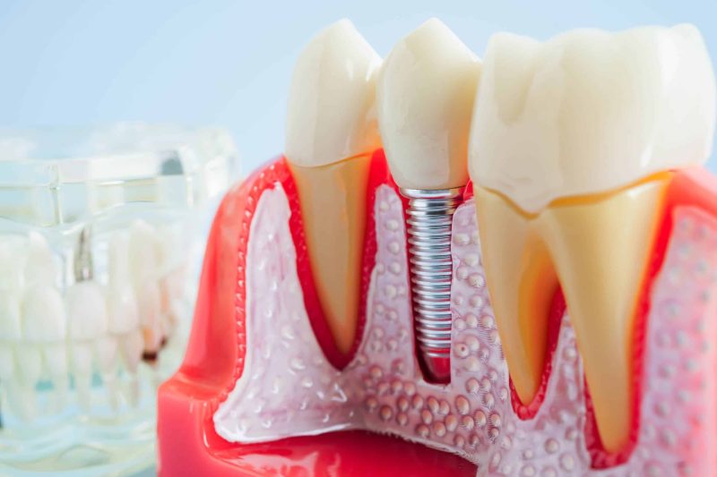 Artificial,Tooth,Roots,Dental,Implant,Into,Jaw,,Root,Canal,Model full arch dental implants boston